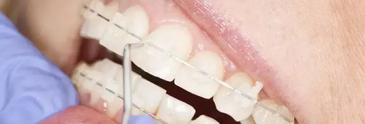 أسرار مقاومة البقع في التقويم الخزفي: كيف يحافظ على بياضه الناصع؟