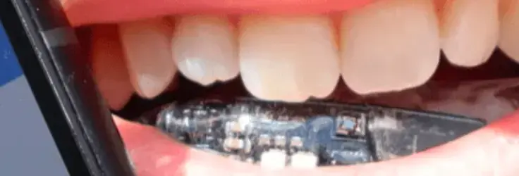 الثورة التقنية في طب الأسنان : دليل شامل عن التقويم المعدني الذكي مع أجهزة استشعار الضغط