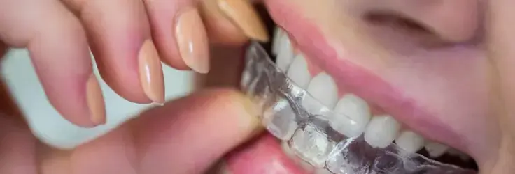 كل ما تحتاج معرفته عن الحل الأمثل لتصحيح الأسنان بالتقويم الشفاف