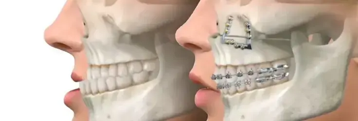 تقويم الأسنان الجراحي ومتى تصبح الجراحة ضرورية لتصحيح الفك؟