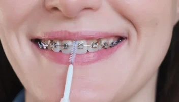 روتين العناية بالتقويم: دليلك الشامل للحفاظ على أسنانك صح