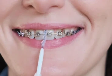 روتين العناية بالتقويم: دليلك الشامل للحفاظ على أسنانك صح