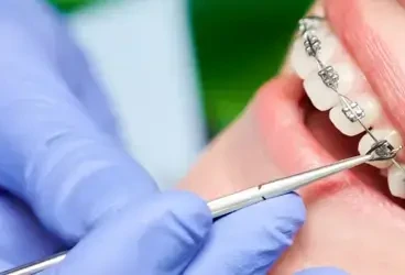 التقويم المعدني ومميزاته و العيوب 2025 [دليل شامل]