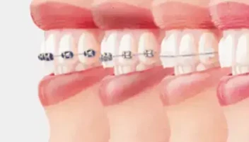 مقارنة بين التقويم السيراميكي والمعدني و أيهما أفضل لعلاج أسنانك في 2025؟