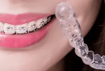 مدة العلاج بتقويم الشفاف كل ما تحتاج معرفته عن الفترة الزمنية