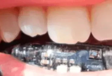 الثورة التقنية في طب الأسنان : دليل شامل عن التقويم المعدني الذكي مع أجهزة استشعار الضغط