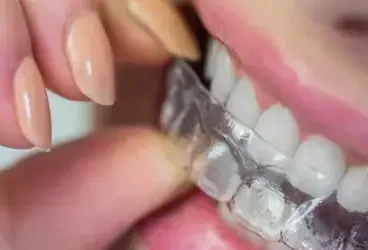 كل ما تحتاج معرفته عن الحل الأمثل لتصحيح الأسنان بالتقويم الشفاف